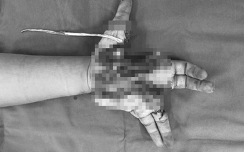 Cháu trai 14 tuổi bị dập nát bàn tay do điện thoại bất ngờ phát nổ