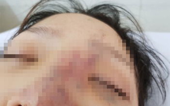 Lại nhập viện vì nguy cơ mù mắt do tiêm filler ở spa