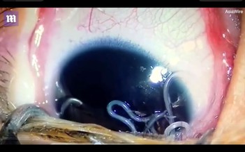 Gắp 11 con giun sống ra khỏi mắt cậu bé 5 tháng tuổi