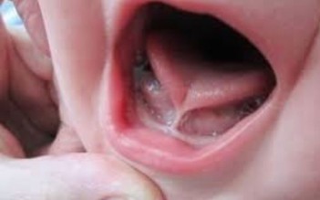Phẫu thuật không chảy máu điều trị dị tật dính lưỡi