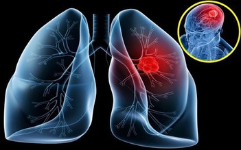 Chụp cắt lớp vi tính liều thấp tăng khả năng sàng lọc ung thư phổi