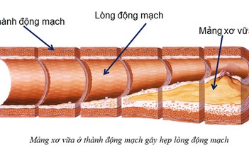 Các yếu tố nguy cơ của bệnh động mạch vành