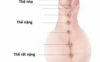 Dị tật lỗ tiểu thấp ở trẻ trai