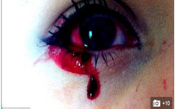 Cô gái bị bệnh lạ chảy máu mắt mỗi ngày
