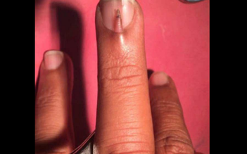 Chàng trai chịu đau đớn vì có 2 móng tay trên 1 ngón tay
