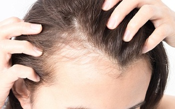 4 nguyên nhân bất ngờ gây ngứa da đầu