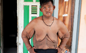 Cậu bé mập nhất thế giới đã giảm được 106 kg