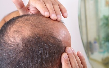 Thử nghiệm mới phát hiện cách hiệu quả để trị hói đầu?