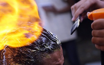 Dùng lửa để tạo kiểu tóc, nam thanh niên nhập viện vì bỏng nặng