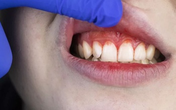 Làm sao để phân biệt đau là do răng hay nướu?