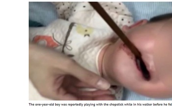 Trung Quốc: Phẫu thuật lấy đũa kẹt trong miệng trẻ 1 tuổi