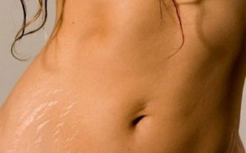 Bụng, đùi, mông bị rạn da do mang thai nên điều trị bằng cách nào?