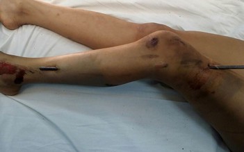 Cứu 1 nạn nhân bị cây sắt xuyên từ cổ chân đến đùi