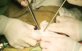 Phẫu thuật nội soi lấy gần 100 gram tóc ra khỏi ruột bé gái