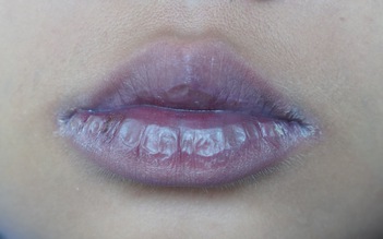 Nhiễm Omicron, thấy dấu hiệu này ở môi cần cấp cứu ngay