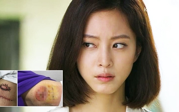 Mỹ nhân Han Ye Seul bị lở loét sau phẫu thuật