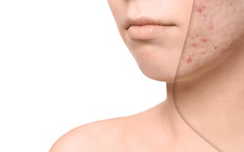 Điều trị sẹo lõm cần nắm bắt ngay bảng thành phần ‘vàng’ sau đây