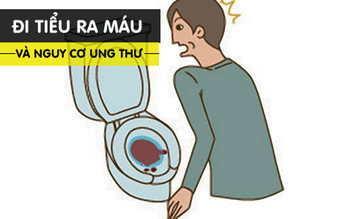 Đi tiểu ra máu: Dấu hiệu mắc ung thư biểu mô tế bào thận