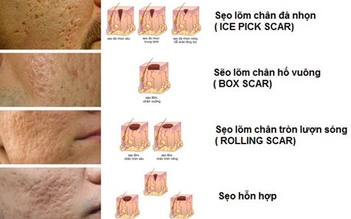 Bị sẹo rỗ trên mặt do mụn để lại có trị hết được không?