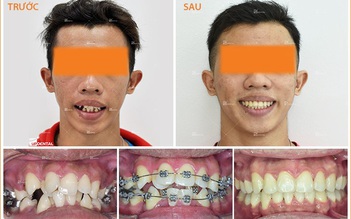 Vì sao răng bị hô, lệch lạc… nên niềng mắc cài kim loại?