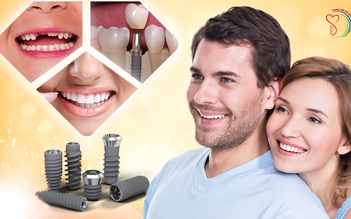 Chia sẻ trải nghiệm thực tế cấy ghép răng implant không đau