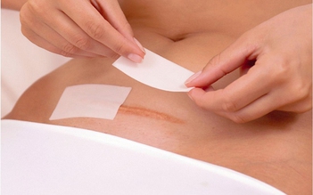 Hé lộ bí quyết trị sẹo lồi dành cho các mẹ mổ sau sinh
