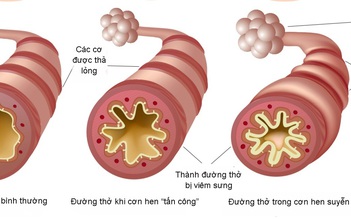 Giải pháp cải thiện ho, khò khè, khó thở