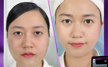 Doctor Beauty giúp Lâm Vỹ Dạ xóa nhăn cấp tốc