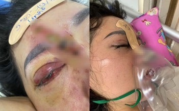 Đà Nẵng: Biến chứng do tiêm filler nâng mũi, một cô gái bị hoại tử mắt