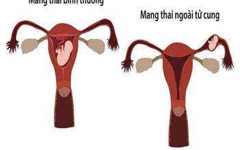 Cứu bệnh nhân nguy kịch do vỡ thai ngoài tử cung