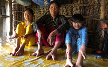 'Dị nhân' miền Tây: Gia đình 3 đời tay chân chỉ 2-3 ngón, vẫn luôn lạc quan làm ăn