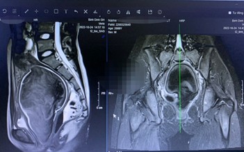 Phẫu thuật thành công cho nữ bệnh nhân bị dị dạng sinh dục hiếm gặp