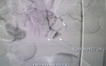 Cứu người đàn ông bị vỡ phình động mạch tạng nguy kịch
