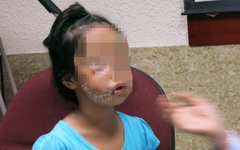 Bé gái bị chó cắn rách mặt, phải dùng hơn 7 m chỉ may vết thương