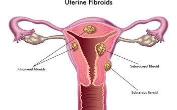 Bác sĩ ơi: Bị u xơ tử cung có nguy cơ bị hiếm muộn không?
