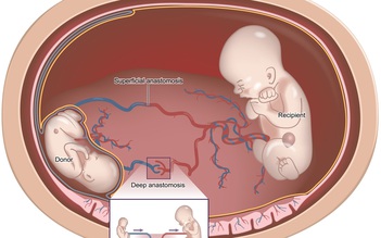 Lần đầu tiên trị 'anh em đánh nhau trong bụng mẹ'