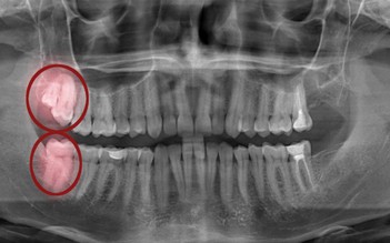 Những điều bạn cần biết về răng khôn