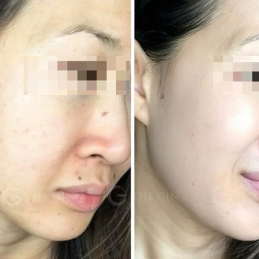 Liệu pháp peel da an toàn được chuyên gia tin tưởng, thay thế filler và botox