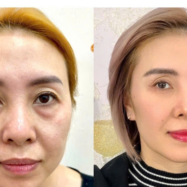 Xóa tan quầng thâm mắt bằng công nghệ Hydro Ultra Lift