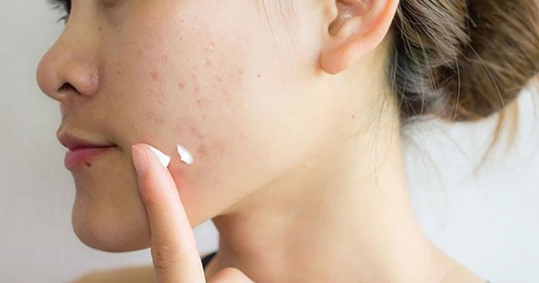 7 loại serum trị mụn cho da dầu nhạy cảm bạn nên thử