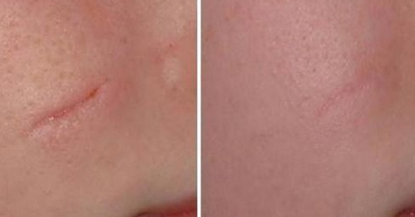 Scar Esthetique là kem trị sẹo thâm mụn có hiệu quả không?
