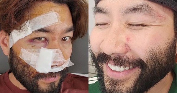 สุขภาพของ MC ชาวเกาหลีหลังจากประสบอุบัติเหตุทางรถยนต์ในเวียดนาม