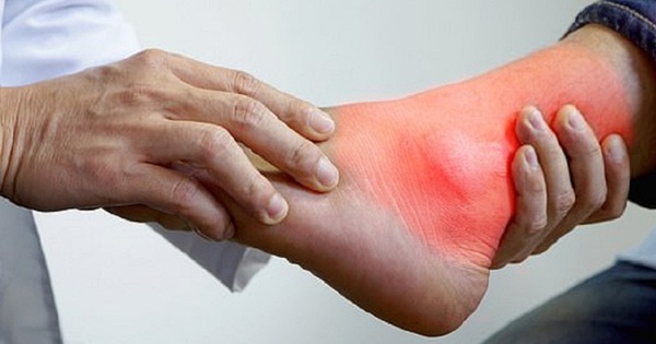 Bệnh gout có ảnh hưởng đến sức khỏe tổng quát không và có thể gây ra những biến chứng nào?