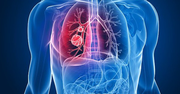 Khó thở và thở khò khè có thể là dấu hiệu của ung thư phổi?
