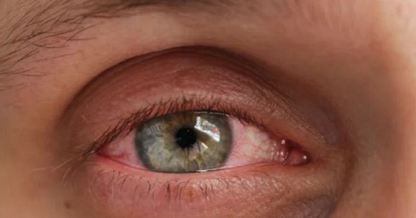 Triệu chứng đi kèm với đau mắt đỏ 1 bên là gì?
