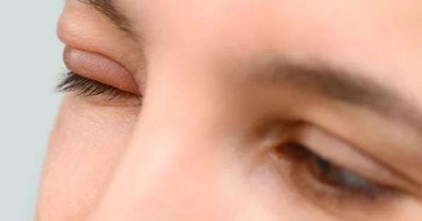 Cách phòng ngừa mụn lẹo mắt để tránh lây nhiễm cho người khác? 
