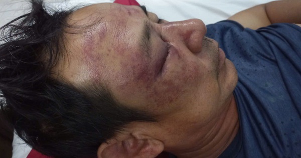 usband Và jist Controversy: 2 Vợ Chồng Bị Hành Hung Tại Nhà Do Luật Sửa Cây Đăng Mạng Xã Hội