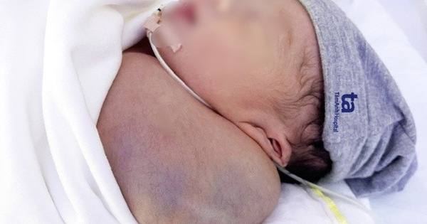 Bé trai sơ sinh có khối u nặng gần 1/3 cơ thể