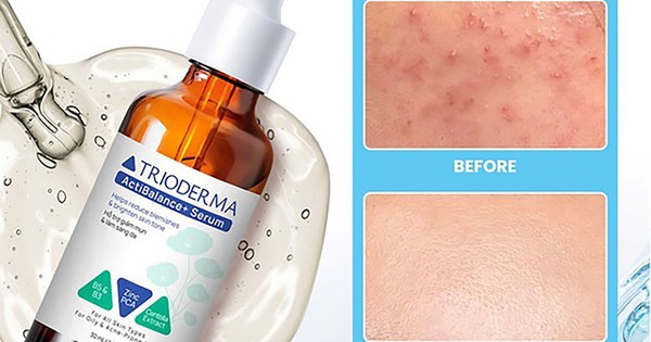 Hướng dẫn sử dụng serum giúp ngừa mụn Trioderma đúng chuẩn chuyên gia cho da khỏe đẹp