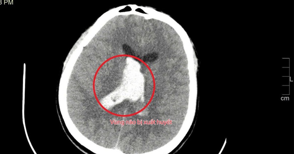 Cứu sống một thầy giáo trẻ bị đột quỵ nguy kịch